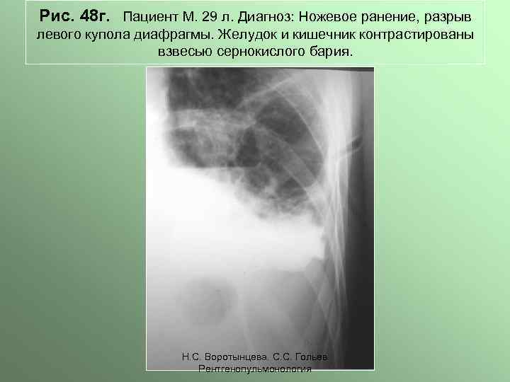 Рис. 48 г. Пациент М. 29 л. Диагноз: Ножевое ранение, разрыв левого купола диафрагмы.