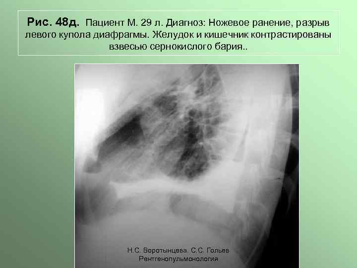 Рис. 48 д. Пациент М. 29 л. Диагноз: Ножевое ранение, разрыв левого купола диафрагмы.