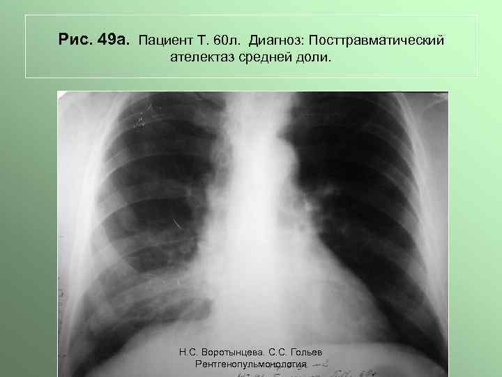 Рис. 49 а. Пациент Т. 60 л. Диагноз: Посттравматический ателектаз средней доли. Н. С.