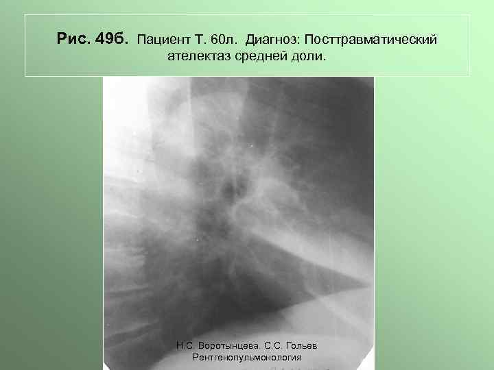 Рис. 49 б. Пациент Т. 60 л. Диагноз: Посттравматический ателектаз средней доли. Н. С.