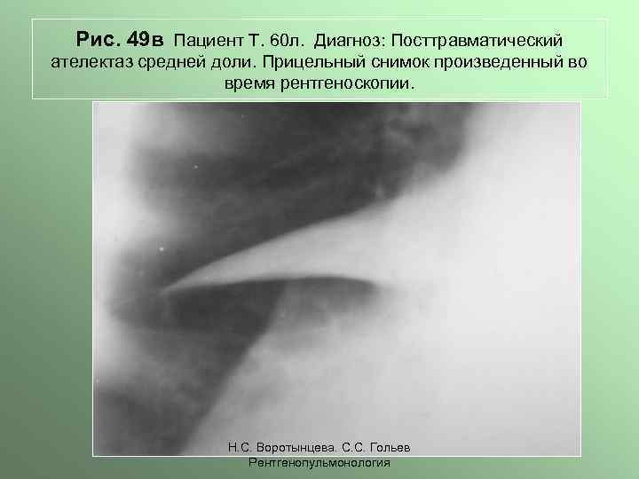 Рис. 49 в Пациент Т. 60 л. Диагноз: Посттравматический ателектаз средней доли. Прицельный снимок
