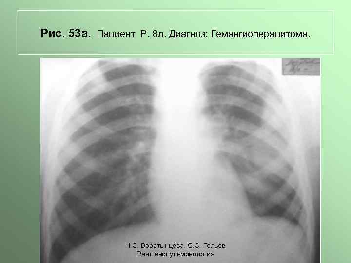 Рис. 53 а. Пациент Р. 8 л. Диагноз: Гемангиоперацитома. Н. С. Воротынцева. С. С.