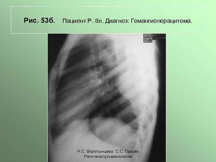 Рис. 53 б. Пациент Р. 8 л. Диагноз: Гемангиоперацитома. Н. С. Воротынцева. С. С.