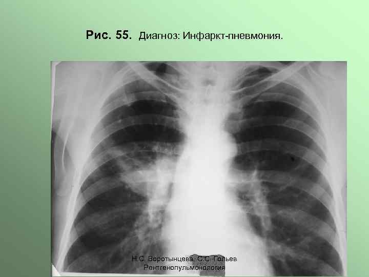 Рис. 55. Диагноз: Инфаркт-пневмония. Н. С. Воротынцева. С. С. Гольев Рентгенопульмонология 