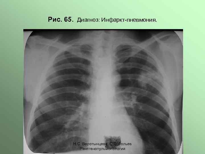 Рис. 65. Диагноз: Инфаркт-пневмония. Н. С. Воротынцева. С. С. Гольев Рентгенопульмонология 