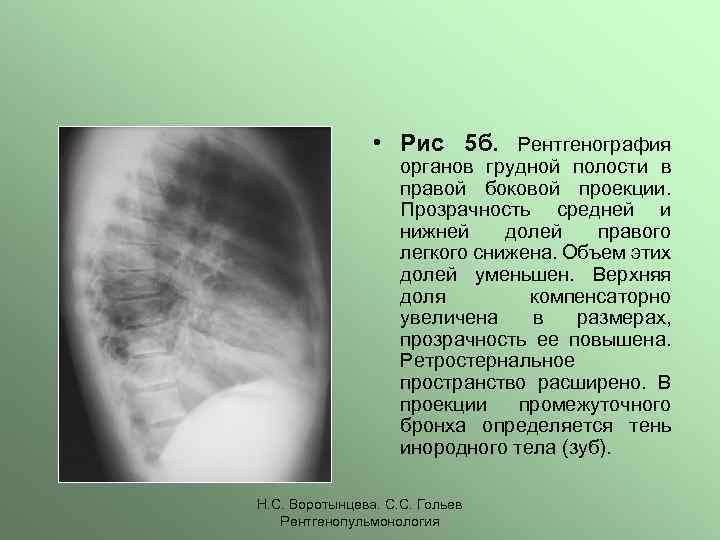 Рентгенограмма в боковой проекции. Рентгенография боковая проекция. Рентгенограмма грудной клетки в боковой проекции.