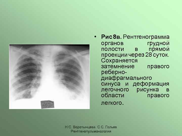  • Рис 8 в. Рентгенограмма органов грудной полости в прямой проекции через 28