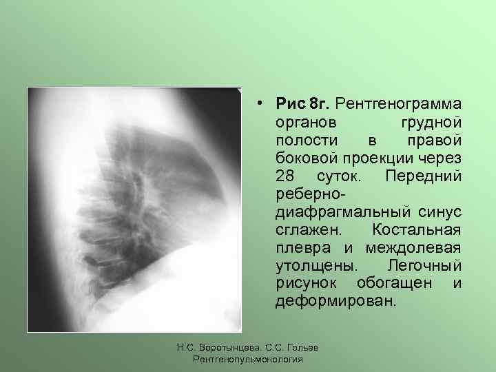 Перисциссурит рентген картина