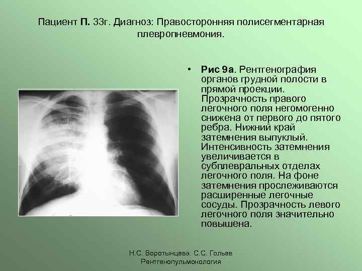 Правосторонняя плевропневмония