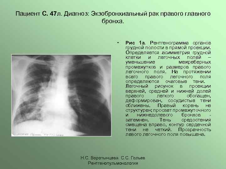 Легочный рисунок деформирован что это значит