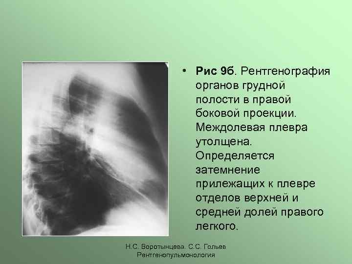 Уплотненная междолевая плевра