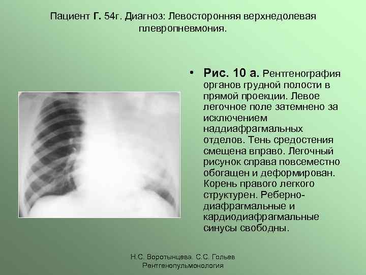 Плевропневмония. Плевропневмония на рентгенограмме. Плевропневмония диагноз. С 54 диагноз. Плевропневмония рентген стадии.