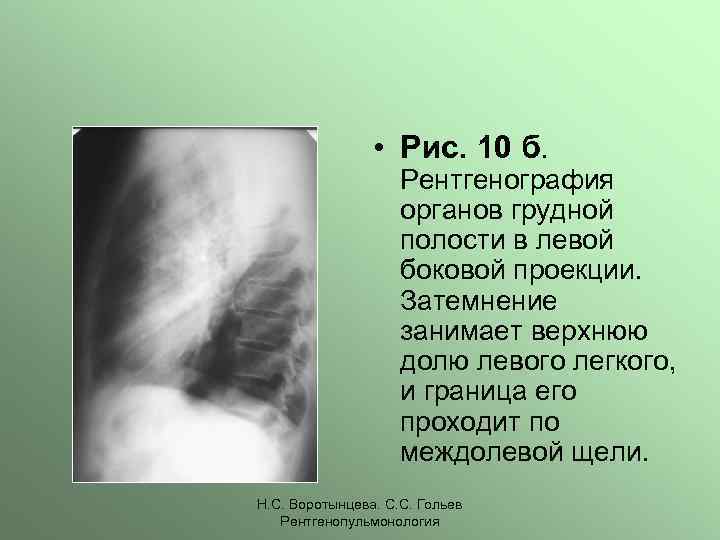  • Рис. 10 б. Рентгенография органов грудной полости в левой боковой проекции. Затемнение