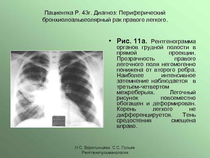 Пациентка Р. 43 г. Диагноз: Периферический бронхиолоальвеолярный рак правого легкого. • Рис. 11 а.