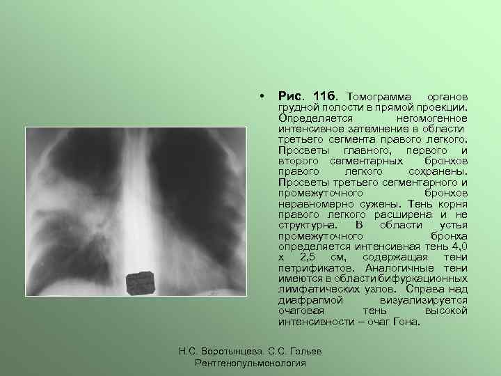  • Рис. 11 б. Томограмма органов грудной полости в прямой проекции. Определяется негомогенное