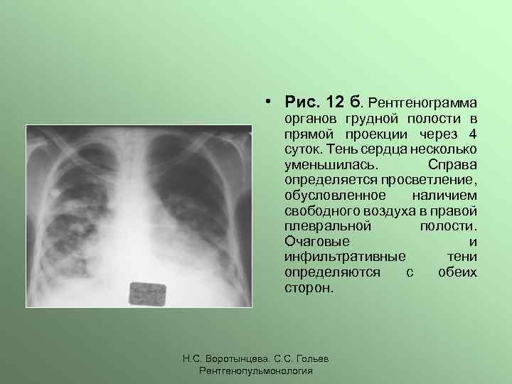  • Рис. 12 б. Рентгенограмма органов грудной полости в прямой проекции через 4