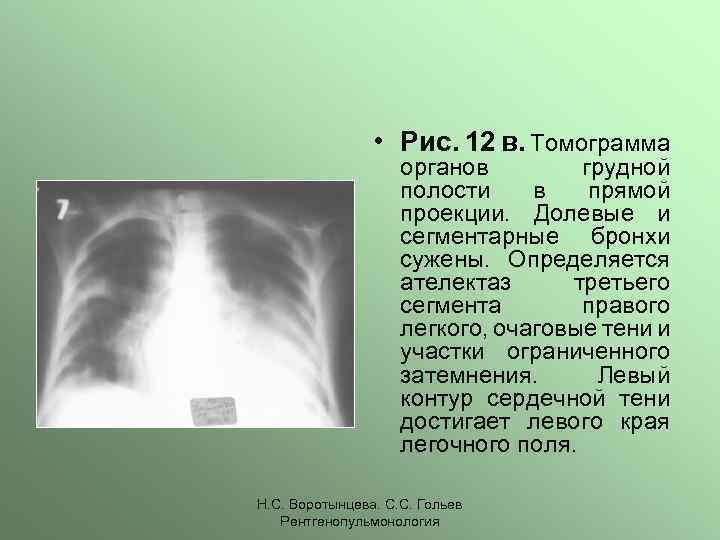 Ателектазы рентген схема