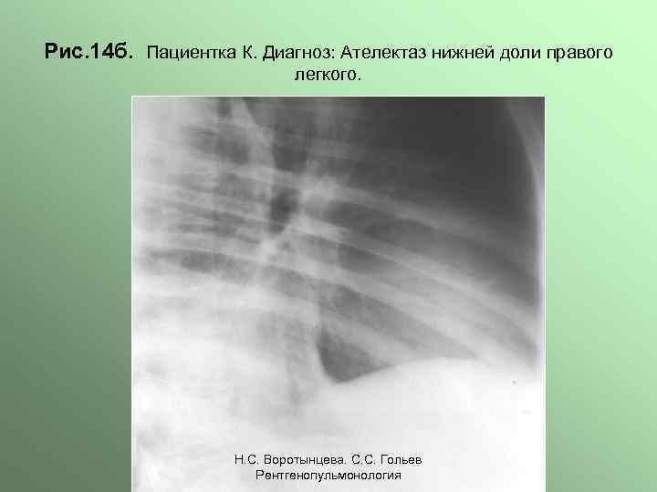 Рис. 14 б. Пациентка К. Диагноз: Ателектаз нижней доли правого легкого. Н. С. Воротынцева.