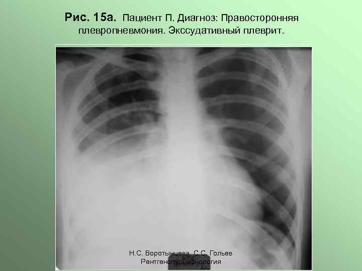 Рис. 15 а. Пациент П. Диагноз: Правосторонняя плевропневмония. Экссудативный плеврит. Н. С. Воротынцева. С.