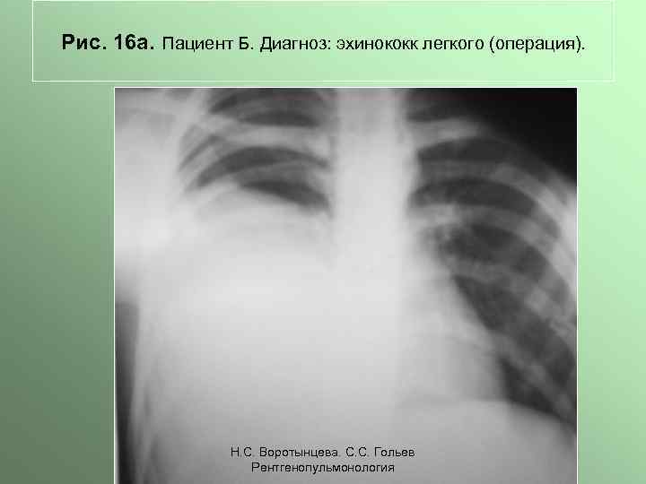 Рис. 16 а. Пациент Б. Диагноз: эхинококк легкого (операция). Н. С. Воротынцева. С. С.