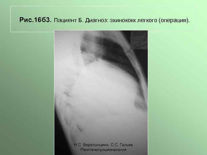 Рис. 16 б 3. Пациент Б. Диагноз: эхинококк легкого (операция). Н. С. Воротынцева. С.
