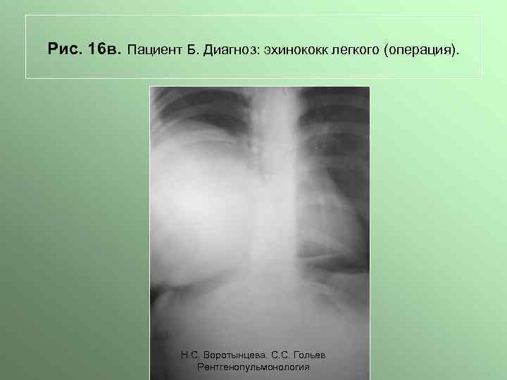 Рис. 16 в. Пациент Б. Диагноз: эхинококк легкого (операция). Н. С. Воротынцева. С. С.