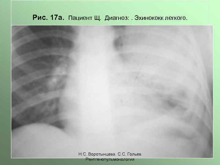 Рис. 17 а. Пациент Щ. Диагноз: . Эхинококк легкого. Н. С. Воротынцева. С. С.