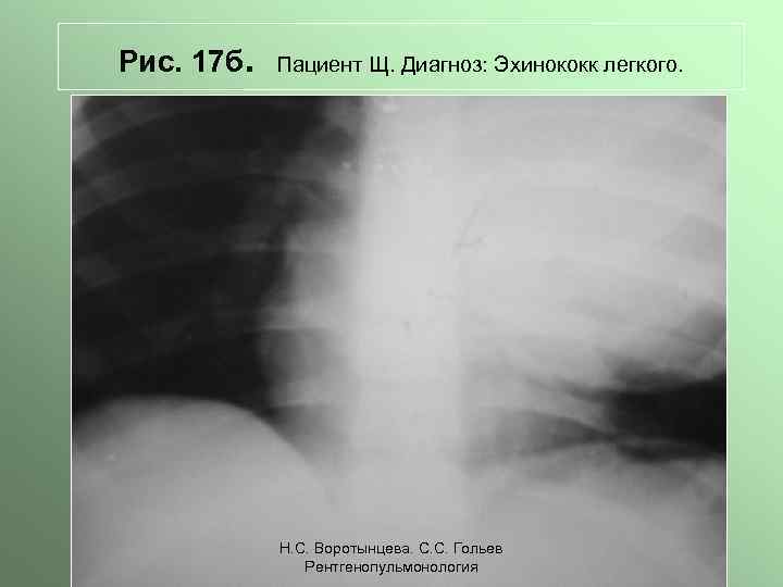 Рис. 17 б. Пациент Щ. Диагноз: Эхинококк легкого. Н. С. Воротынцева. С. С. Гольев