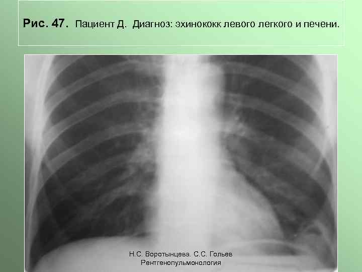 Рис. 47. Пациент Д. Диагноз: эхинококк левого легкого и печени. Н. С. Воротынцева. С.