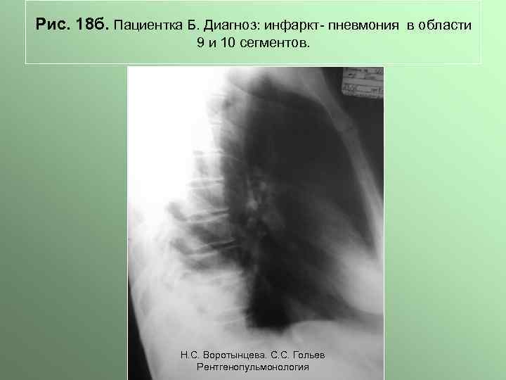 Рис. 18 б. Пациентка Б. Диагноз: инфаркт- пневмония в области 9 и 10 сегментов.