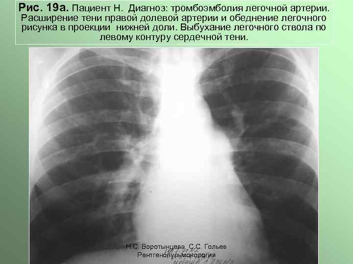 Обеднение сосудистого рисунка легких характерно для