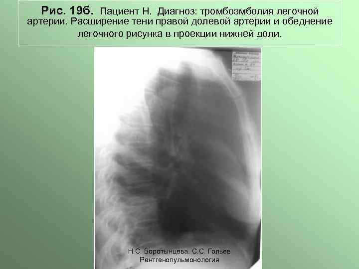 Рис. 19 б. Пациент Н. Диагноз: тромбоэмболия легочной артерии. Расширение тени правой долевой артерии