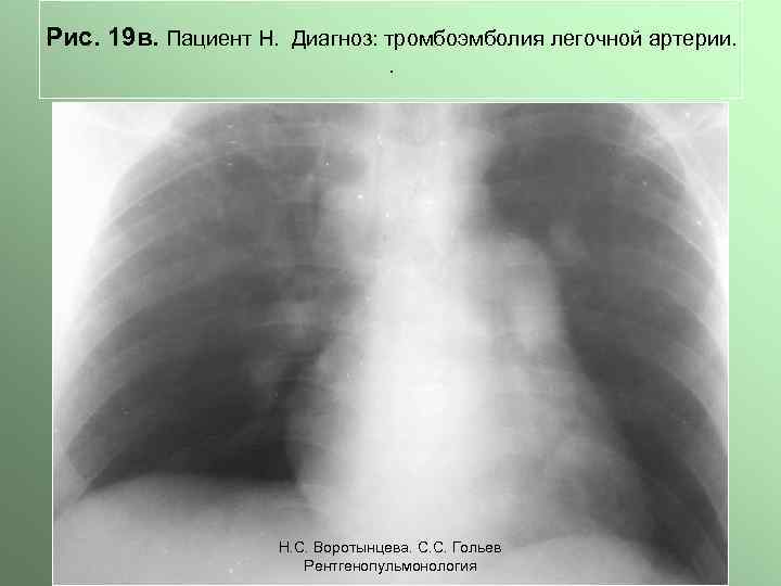 Рис. 19 в. Пациент Н. Диагноз: тромбоэмболия легочной артерии. . Н. С. Воротынцева. С.