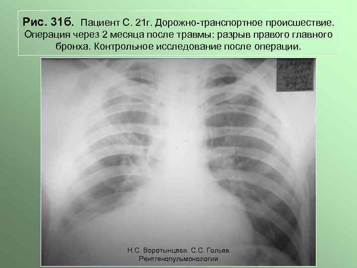 Рис. 31 б. Пациент С. 21 г. Дорожно-транспортное происшествие. Операция через 2 месяца после
