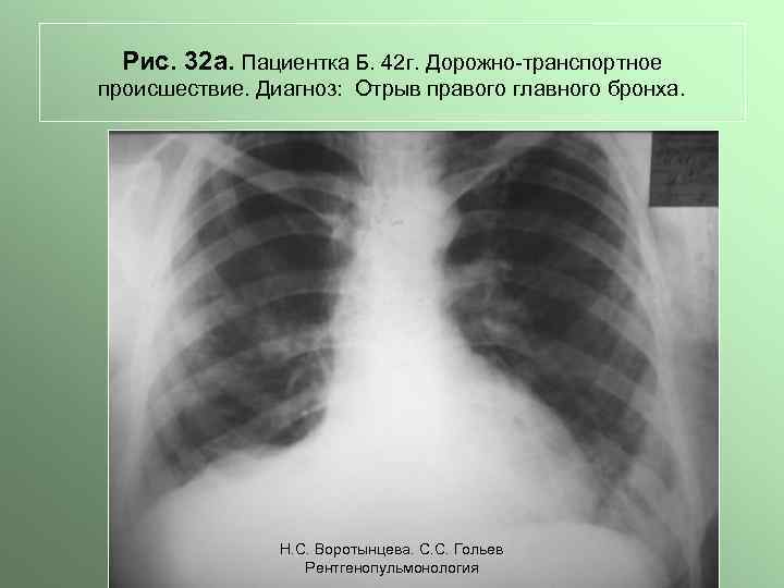 Рис. 32 а. Пациентка Б. 42 г. Дорожно-транспортное происшествие. Диагноз: Отрыв правого главного бронха.