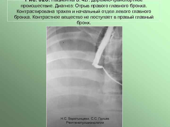 Рис. 32 б. Пациентка Б. 42 г. Дорожно-транспортное происшествие. Диагноз: Отрыв правого главного бронха.