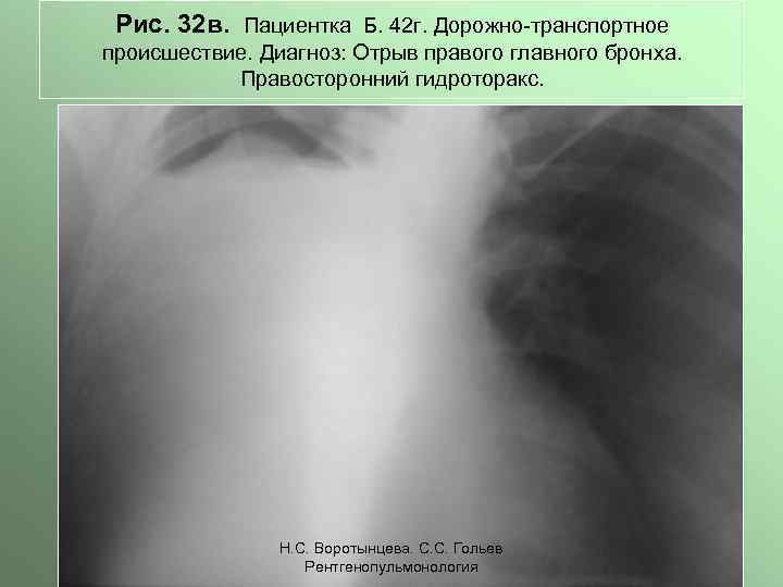Рис. 32 в. Пациентка Б. 42 г. Дорожно-транспортное происшествие. Диагноз: Отрыв правого главного бронха.