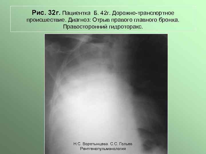 Рис. 32 г. Пациентка Б. 42 г. Дорожно-транспортное происшествие. Диагноз: Отрыв правого главного бронха.