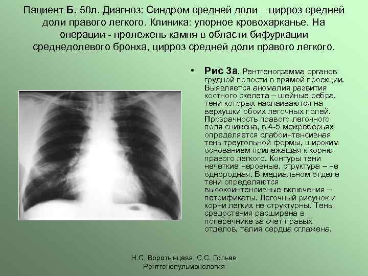 Тень легочного рисунка. Синдром средней доли правого легкого на рентгене. Среднедолевой синдром рентген. Синдром средней доли рентген. Среднедолевой синдром кт.