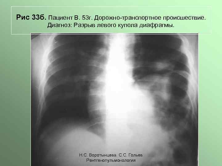 Рис 33 б. Пациент В. 53 г. Дорожно-транспортное происшествие. Диагноз: Разрыв левого купола диафрагмы.