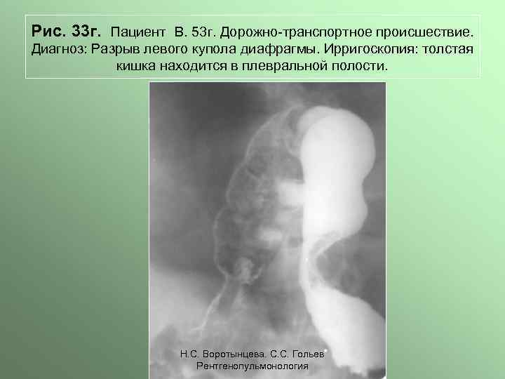 Рис. 33 г. Пациент В. 53 г. Дорожно-транспортное происшествие. Диагноз: Разрыв левого купола диафрагмы.