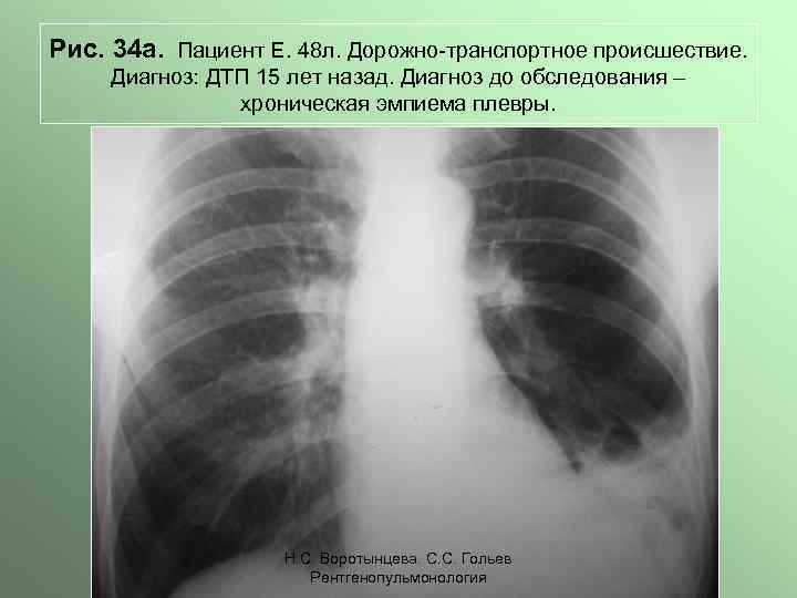 Рис. 34 а. Пациент Е. 48 л. Дорожно-транспортное происшествие. Диагноз: ДТП 15 лет назад.