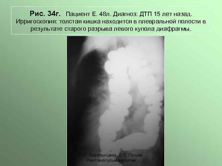 Рис. 34 г. Пациент Е. 48 л. Диагноз: ДТП 15 лет назад. Ирригоскопия: толстая