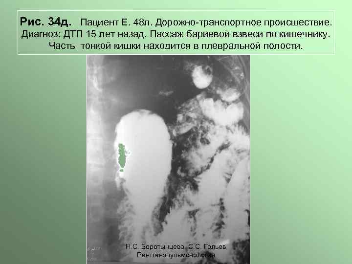 Рис. 34 д. Пациент Е. 48 л. Дорожно-транспортное происшествие. Диагноз: ДТП 15 лет назад.