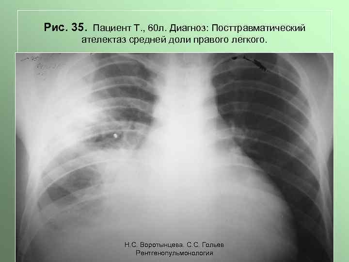 Рис. 35. Пациент Т. , 60 л. Диагноз: Посттравматический ателектаз средней доли правого легкого.