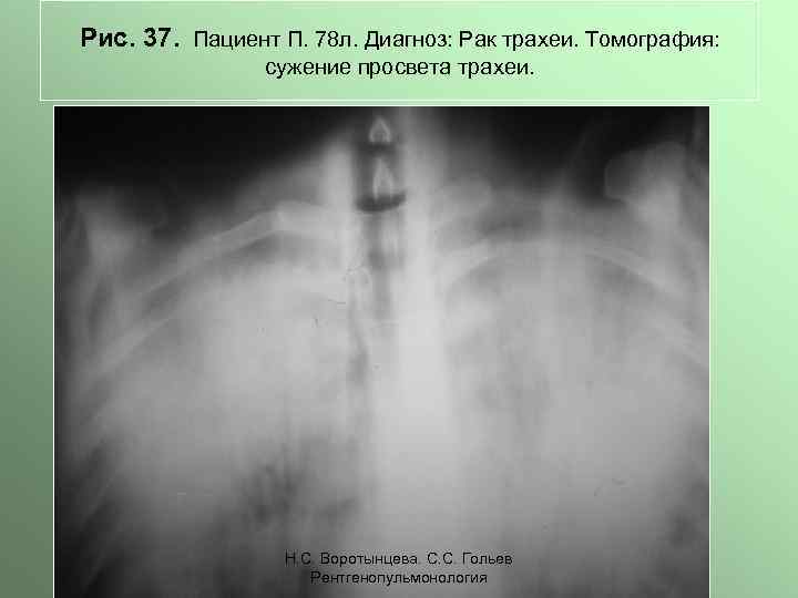 Рис. 37. Пациент П. 78 л. Диагноз: Рак трахеи. Томография: сужение просвета трахеи. Н.