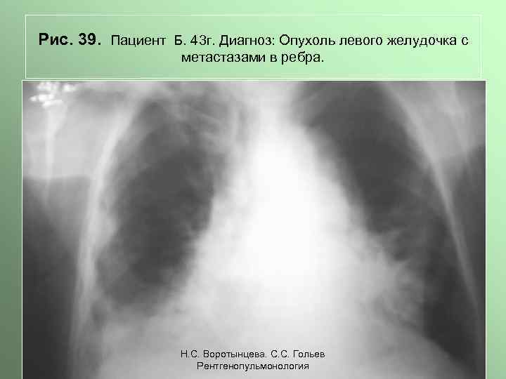 Рис. 39. Пациент Б. 43 г. Диагноз: Опухоль левого желудочка с метастазами в ребра.