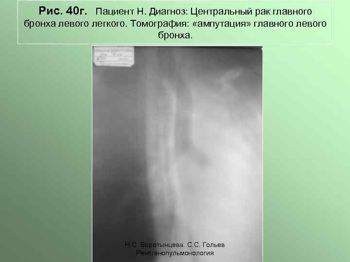 Рис. 40 г. Пациент Н. Диагноз: Центральный рак главного бронха левого легкого. Томография: «ампутация»