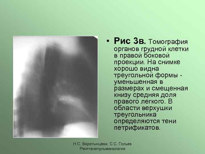 • Рис 3 в. Томография органов грудной клетки в правой боковой проекции. На