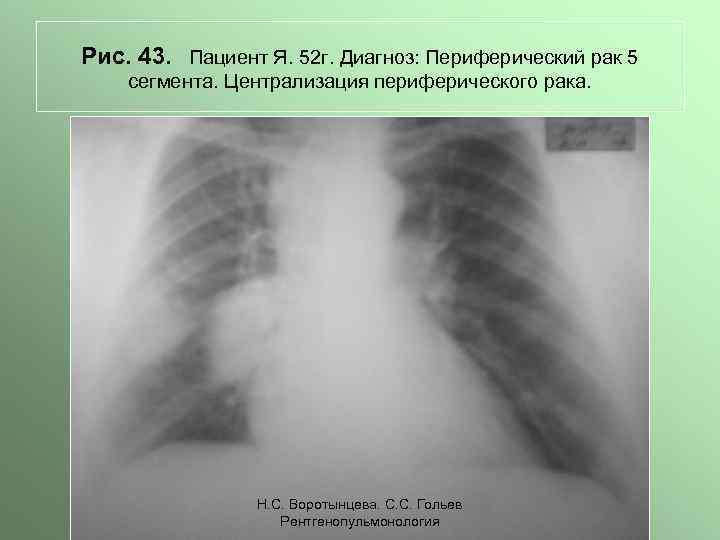 Рис. 43. Пациент Я. 52 г. Диагноз: Периферический рак 5 сегмента. Централизация периферического рака.